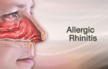 Allergic rhinitis