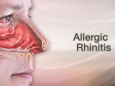 Allergic rhinitis